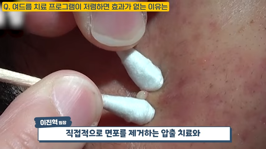 난치성 여드름 치료가 저렴할 수 없는 이유, 여드름 치료 비용 대공개 #난치성여드름 #화농성여드름 #여드름전문한의원 2-23 screenshot.png