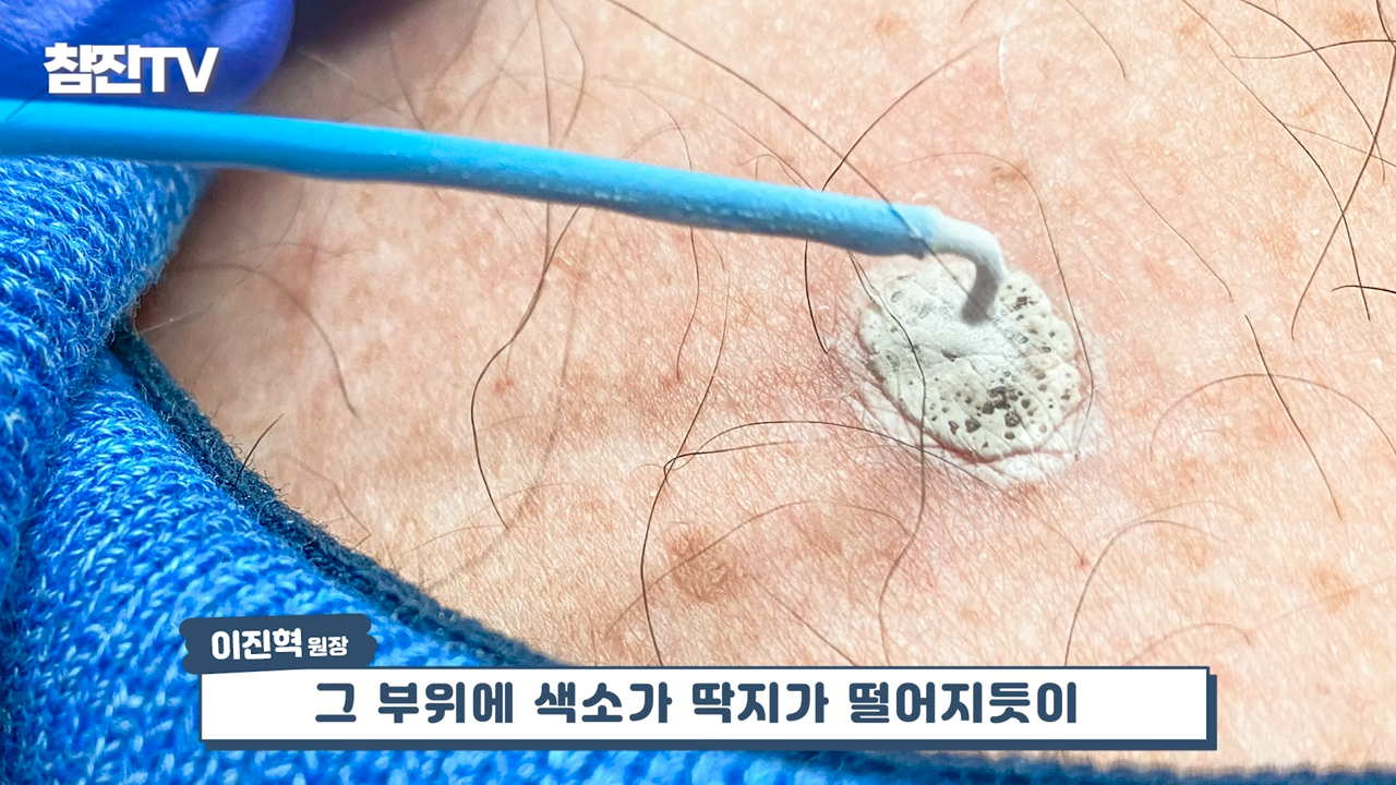 검버섯, 흑자 없애는 방법 공개! 영상 하나로 정리해드립니다! #흑자제거 #검버섯 #여드름흉터 5-13 screenshot.png