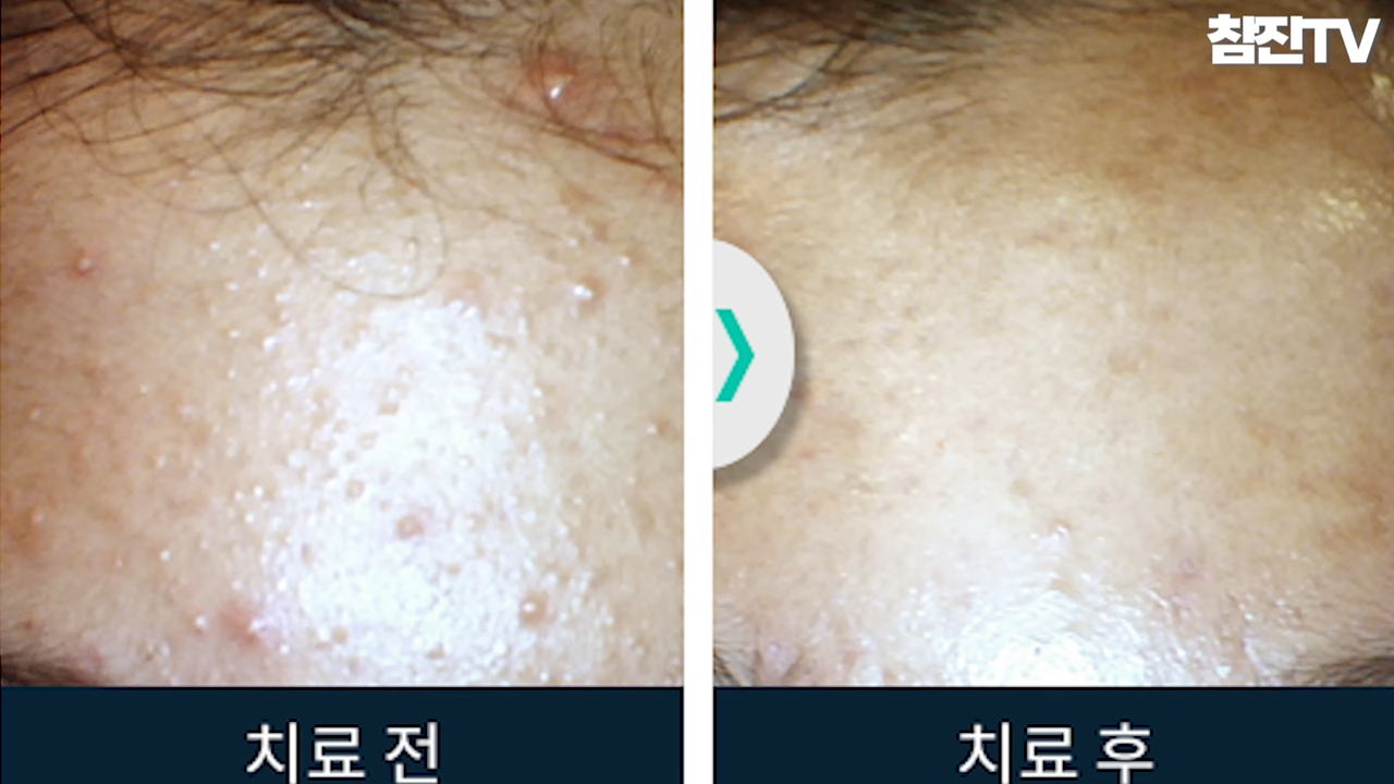 오돌토돌한 좁쌀 여드름이 나는 원인과 예방법 알려드리겠습니다! #좁쌀여드름 #여드름압출 #여드름흉터한의원 1-7 screenshot (1).png