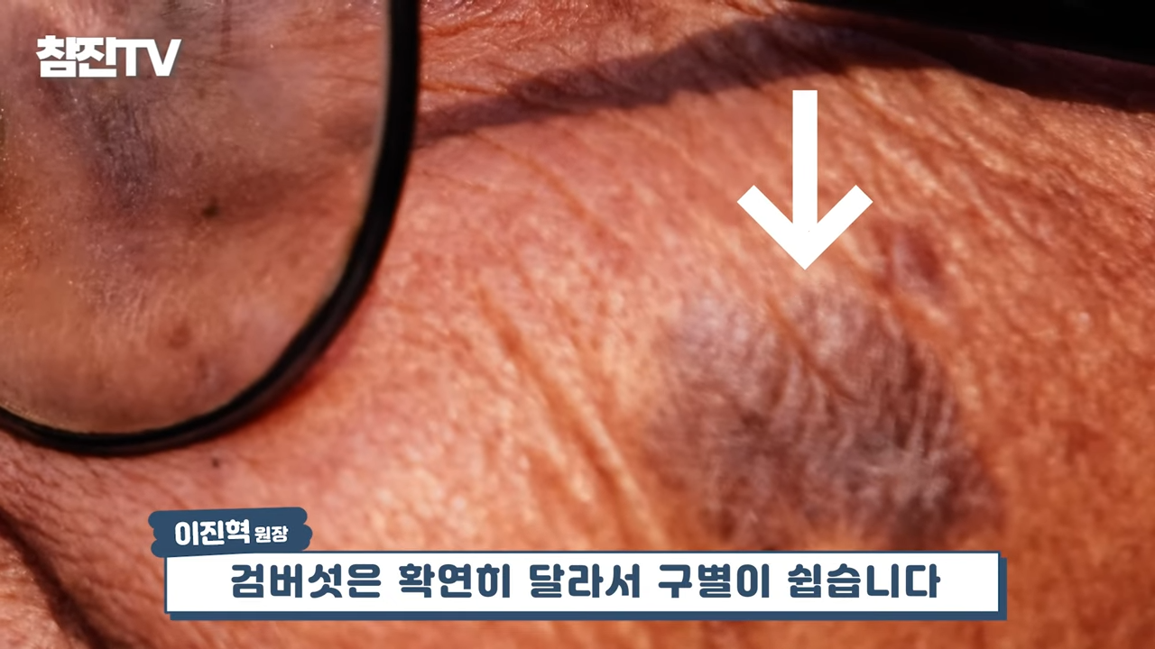 검버섯, 흑자 없애는 방법 공개! 영상 하나로 정리해드립니다! #흑자제거 #검버섯 #여드름흉터 1-32 screenshot.png