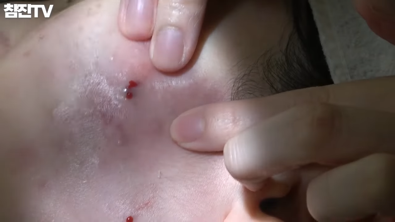 맨손으로 여드름 압출� 이 영상을 꼭 봐주세요 논란 종결!!!� 2-45 screenshot.png