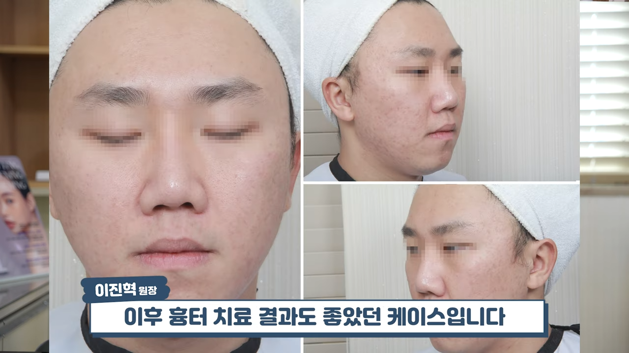 여드름치료 실패 사례� #여드름흉터 #흉터치료 #skincare 2-2 screenshot.png