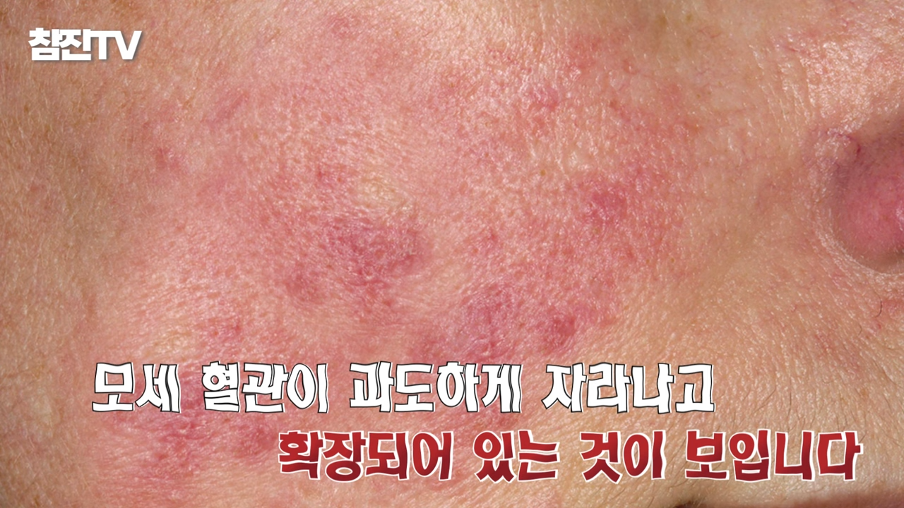 여드름 붉은 자국 흉터 고민 OOO 하나로 끝내드리겠습니다� #여드름압출 #여드름흉터 #여드름 1-39 screenshot.png