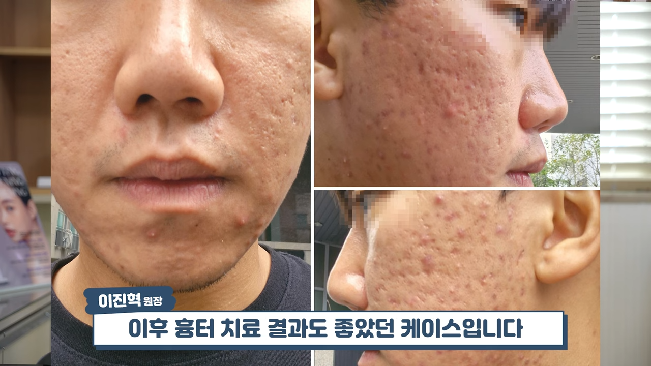 여드름치료 실패 사례� #여드름흉터 #흉터치료 #skincare 2-1 screenshot.png