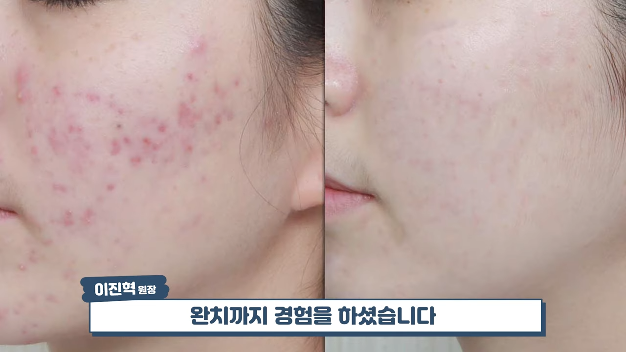 여드름치료 실패 사례� #여드름흉터 #흉터치료 #skincare 2-23 screenshot.png