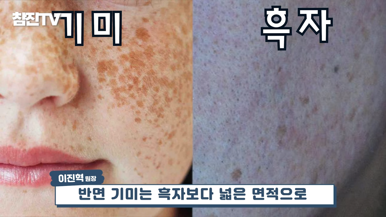 검버섯, 흑자 없애는 방법 공개! 영상 하나로 정리해드립니다! #흑자제거 #검버섯 #여드름흉터 1-16 screenshot.png