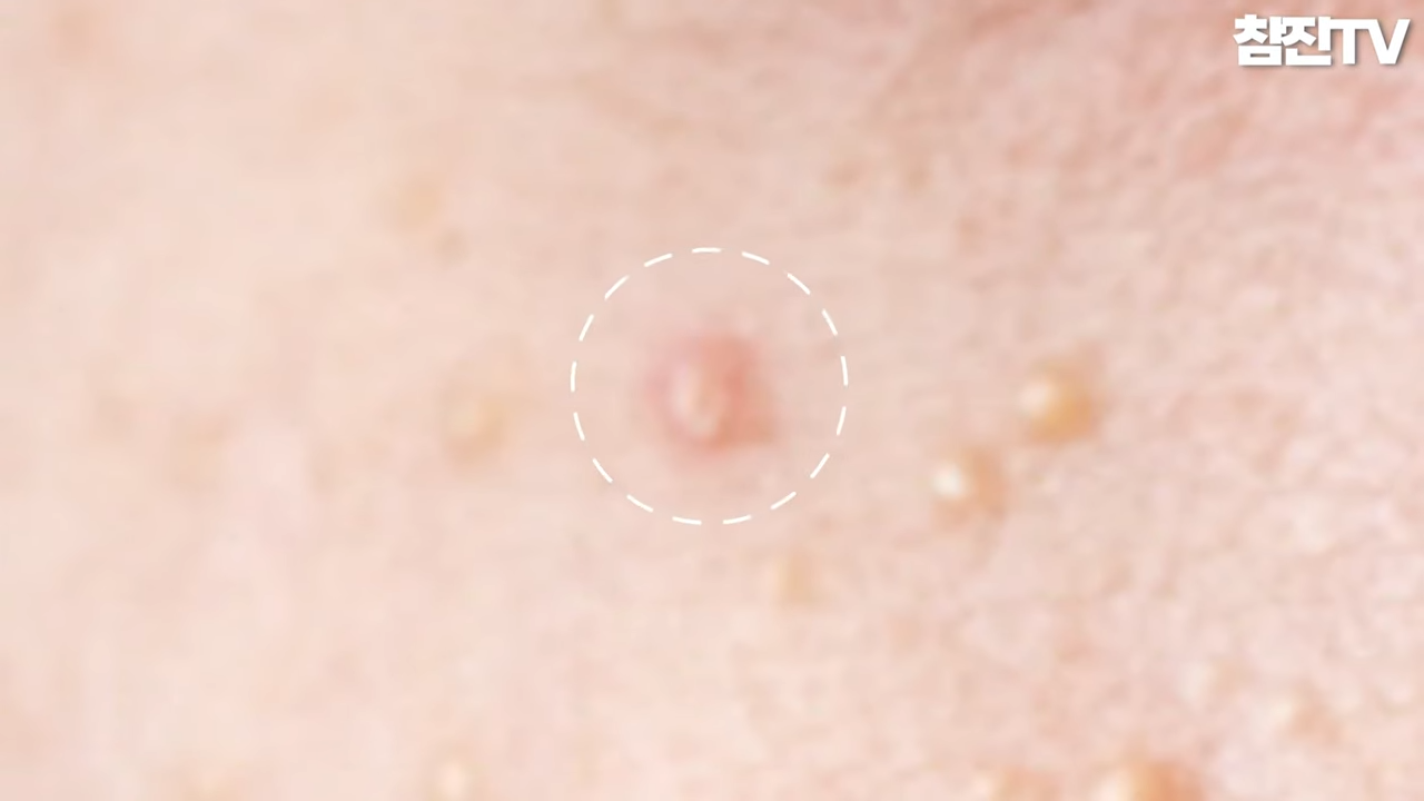 오돌토돌한 좁쌀 여드름이 나는 원인과 예방법 알려드리겠습니다! #좁쌀여드름 #여드름압출 #여드름흉터한의원 1-10 screenshot.png