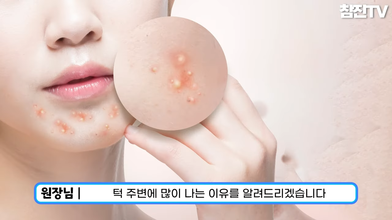 성인여드름☝� 왜 턱 주변에만 나는지 원인과 방법에 대해 알려드립니다!�� 0-21 screenshot.png