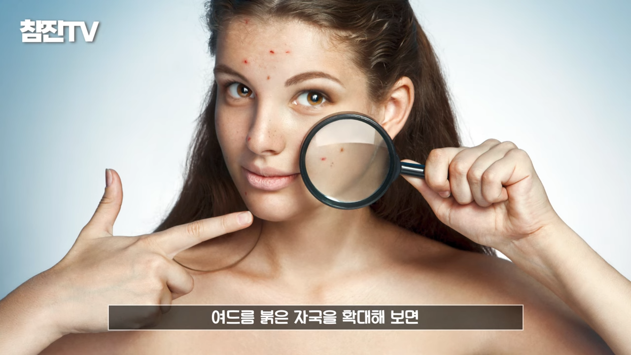 여드름 붉은 자국 흉터 고민 OOO 하나로 끝내드리겠습니다� #여드름압출 #여드름흉터 #여드름 1-37 screenshot.png