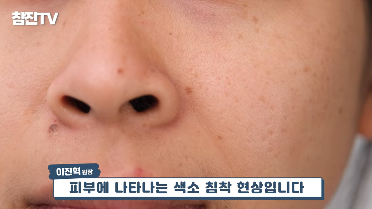 검버섯, 흑자 없애는 방법 공개! 영상 하나로 정리해드립니다! #흑자제거 #검버섯 #여드름흉터 0-40 screenshot.png