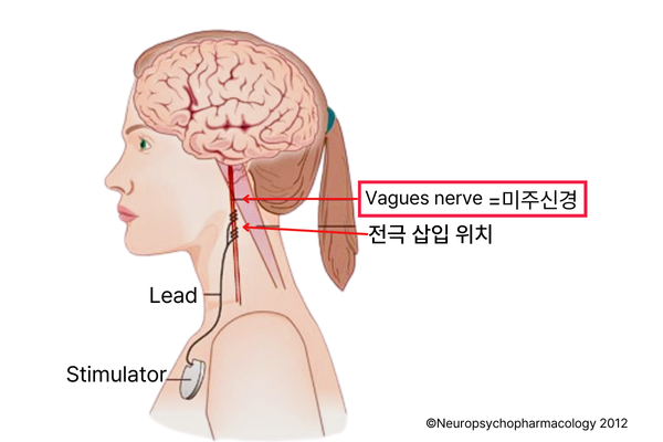 미주신경자극장치.png