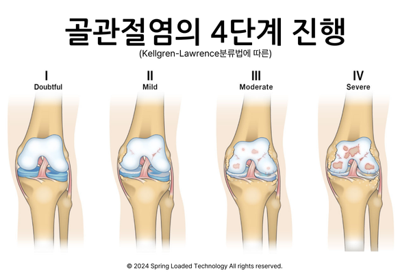골관절염진행.png