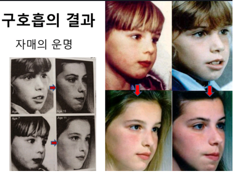 입으로 숨쉬면 안되는 이유.png