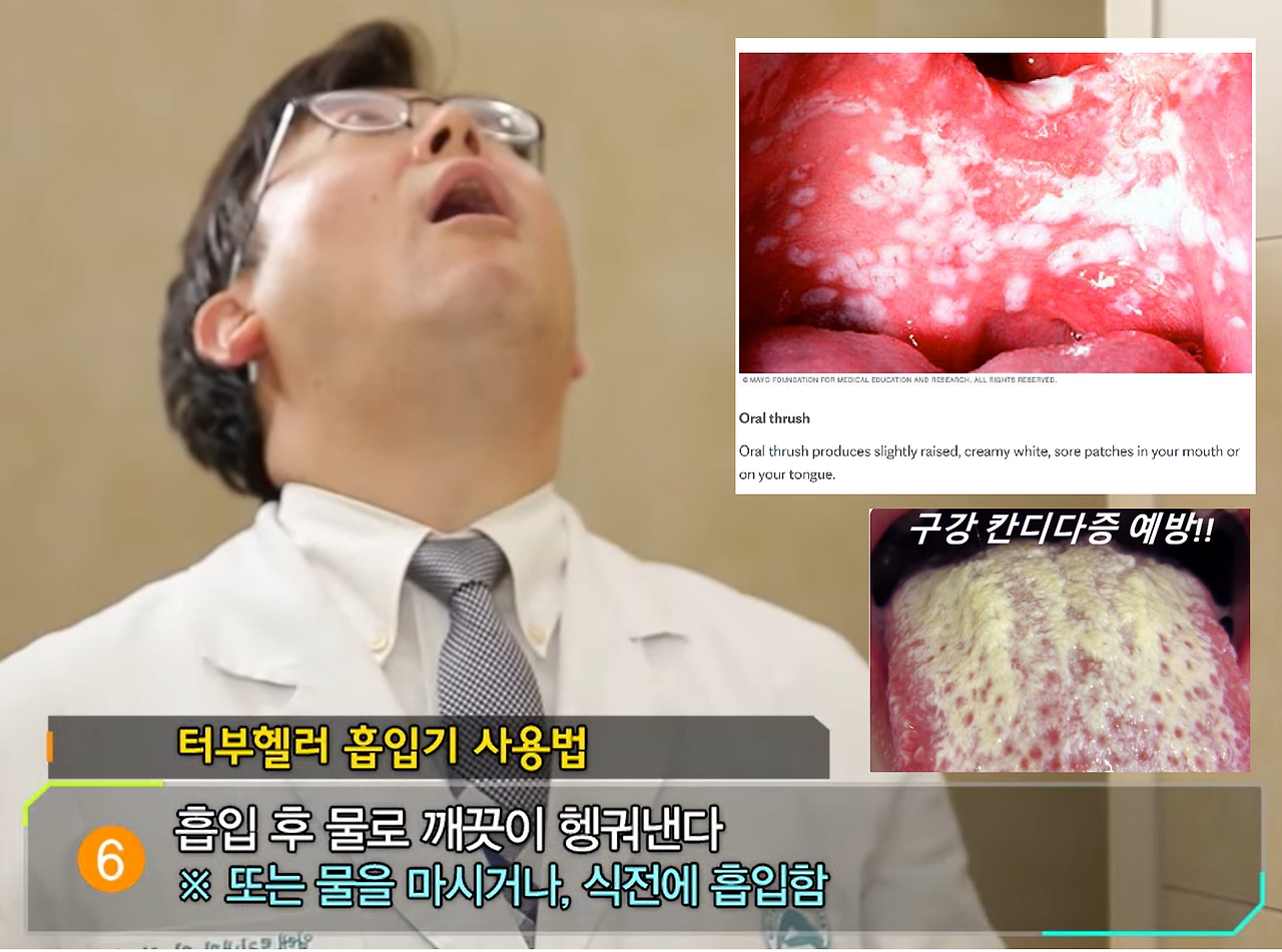 06_oralthrush.png