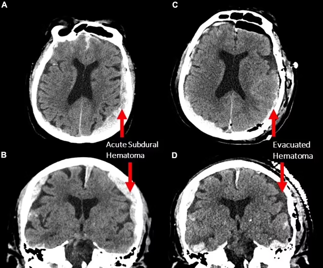 심장마비로 죽어가는 87세 남성 간질환자의 뇌 활동 기록.png