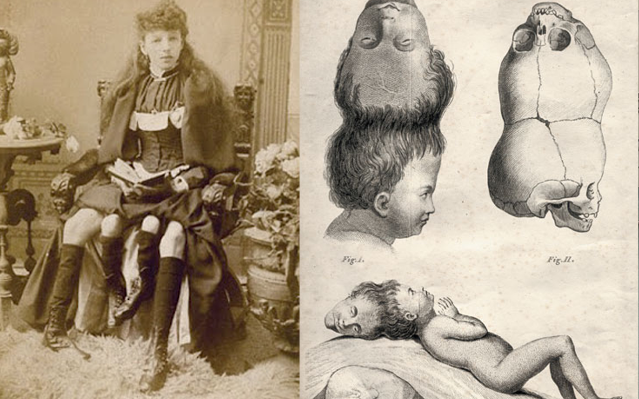 런던의 헌터리언 박물관(Hunterian Museum)은 최초로 기록된 두개골 기생충(craniopagus parasiticus) 1783 년 벵골의 Mundul Gait 마을에서 태어난 아이의 두개골.png