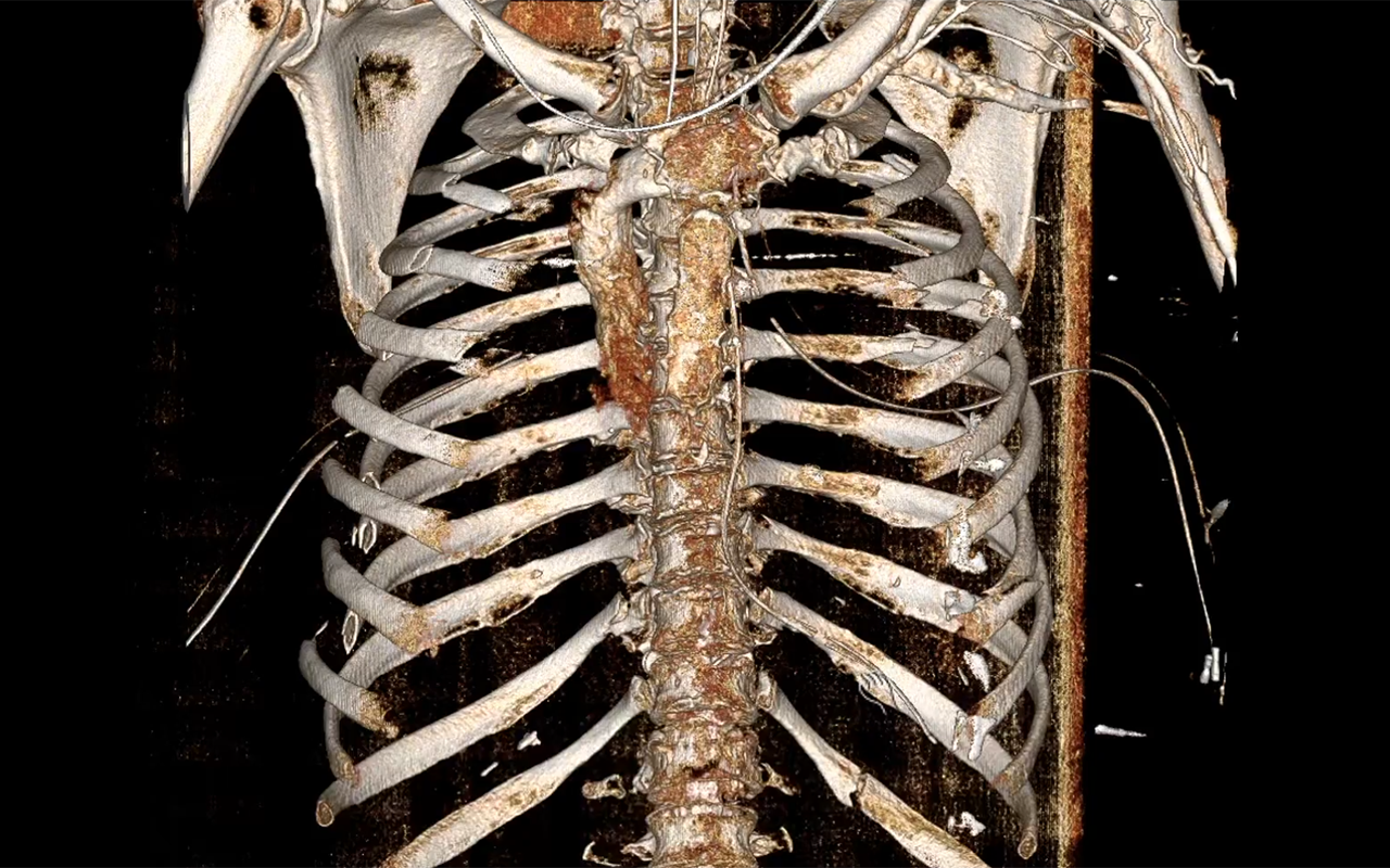 안전벨트 부서진 갈비뼈.png