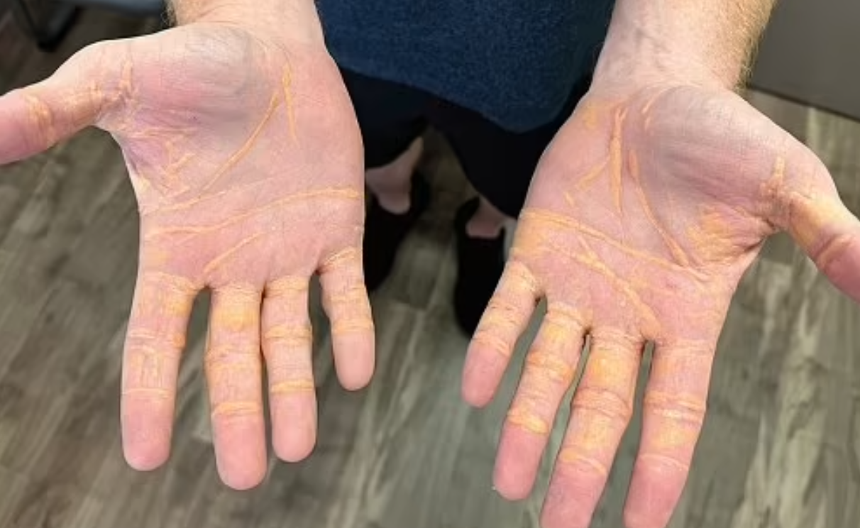 육식 식단을 먹는 한 남자가 콜레스테롤 수치가 너무 높아 콜레스테롤 수치가 손에서 새어 나오기 시작.png