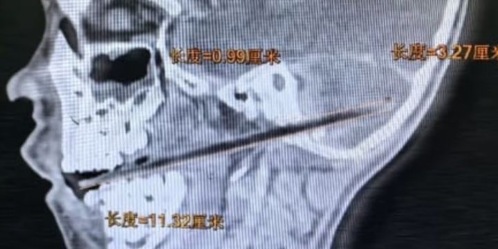 막대사탕 뇌 관통.png