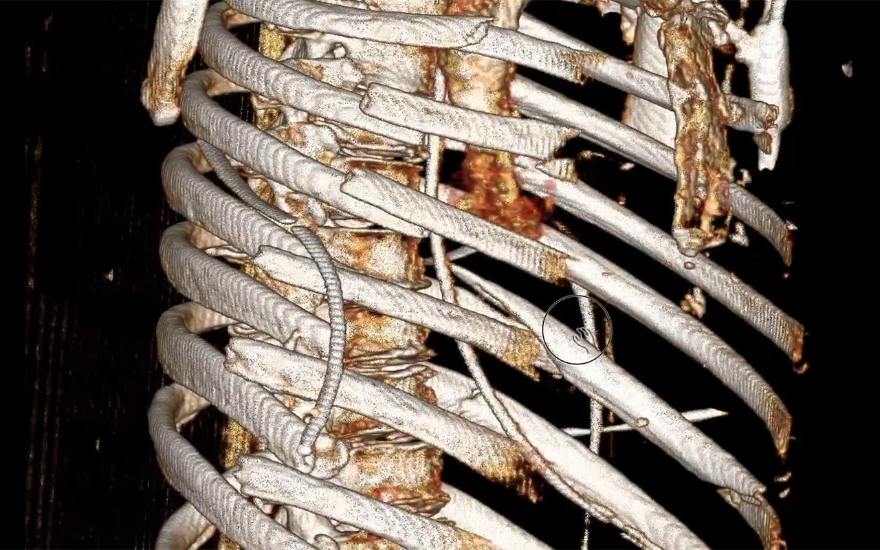 안전벨트 부서진 갈비뼈 EM_RESUS.png