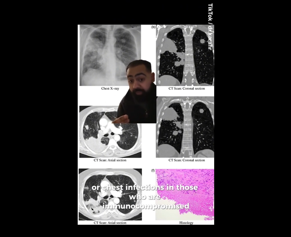 틱톡 게시물에서 NHS 외과 의사 카란 라잔(Karan Rajan) 박사.png