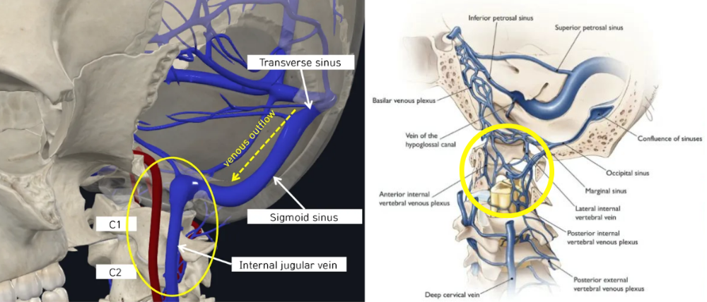 두개정맥혈 정체.png