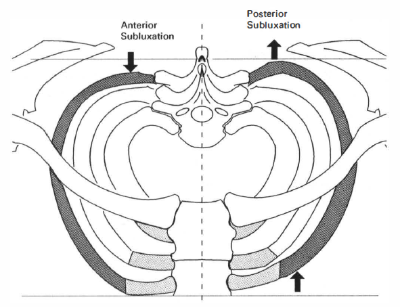 갈비뼈 앞뒤 이탈.png