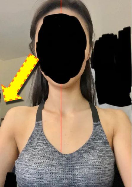 텐세그리티를 교란하는 과긴장 (1).png