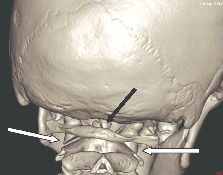 Three-dimensional-CT-scan-showing-the-right-lateral-translatory-subluxation-of-the-atlas.png
