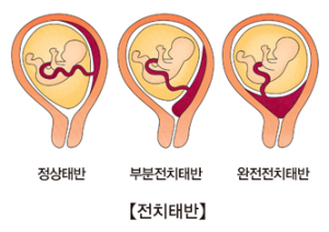 서울아산병원 출처 부분전치태반.png