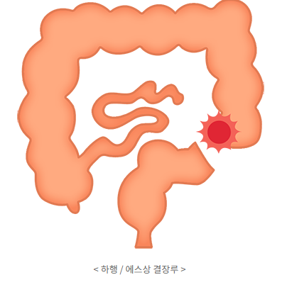 하행결장루.png