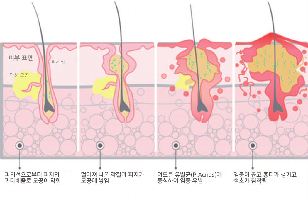 여드름발생과정.png
