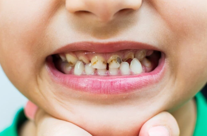 20260318 _ 어릴 때 충치가 많다면…성인 심장병 위험도 함께 높아진다 _ 2-1.png