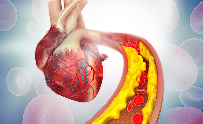 20260226 _ 여성 심장질환, 플라크 적어도 안심 금물인 이유 _ 2-1.png