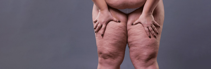 20260304 _ 지방부종, 만성 질환 인정…진단이 바뀐다 _ 2.png