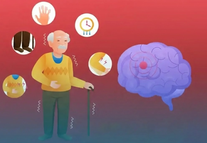 20260220 _ 파킨슨병 ‘걷는 순간’을 감지하는 뇌 임플란트의 진전 _ 2.png