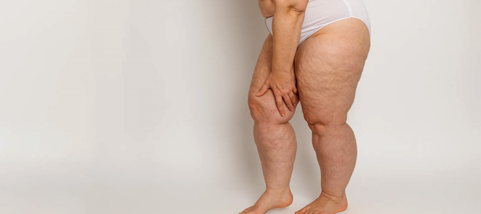 20260304 _ 지방부종, 만성 질환 인정…진단이 바뀐다 _ 2-2.png