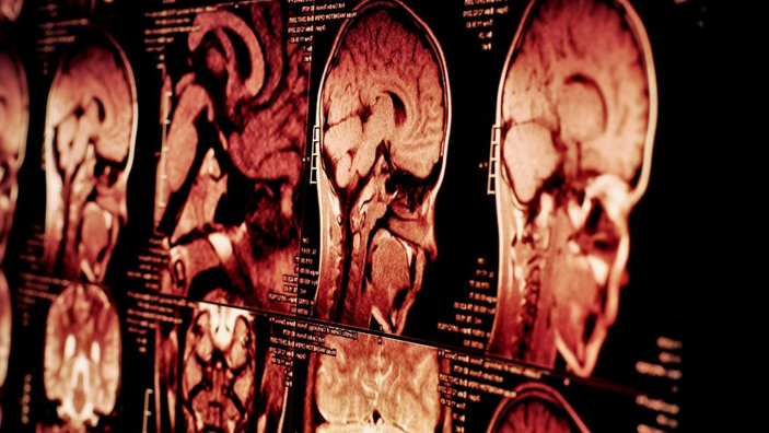 20260311 _ 드디어 밝혀진 ADHD 3가지 유형 _ 2-2.png