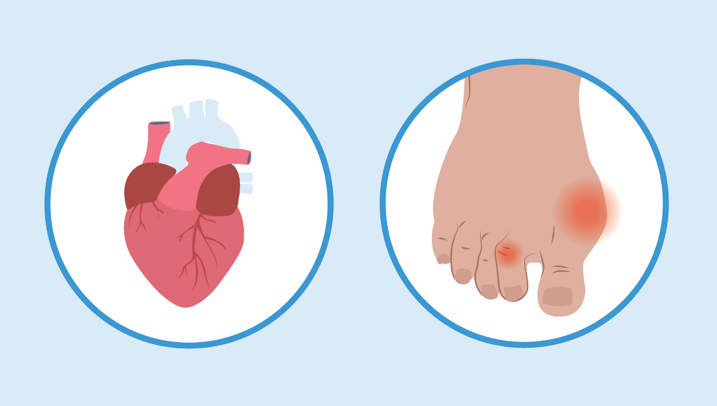 20260205 _ 통풍 치료, 심근경색·뇌졸중 위험도 낮출까 _ 2-2.png