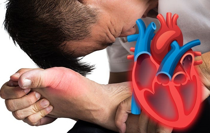 20260205 _ 통풍 치료, 심근경색·뇌졸중 위험도 낮출까 _ 2.png