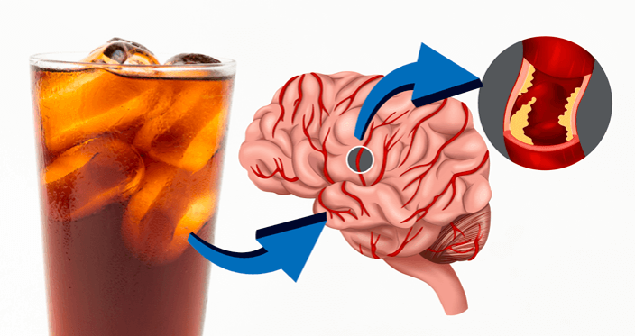 20260206 _ 다이어트 탄산음료, 치매 4배↑ ‘당뇨·비만’이 열쇠 _ 2-1.png