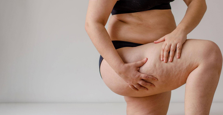 20260304 _ 지방부종, 만성 질환 인정…진단이 바뀐다 _ 2-1.png