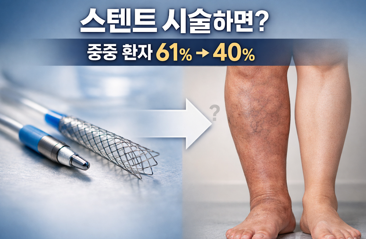 20260420 _ 심부정맥혈전증 후유증, 스텐트 시술로 증상 줄일 수 있다 _ 2-3.png