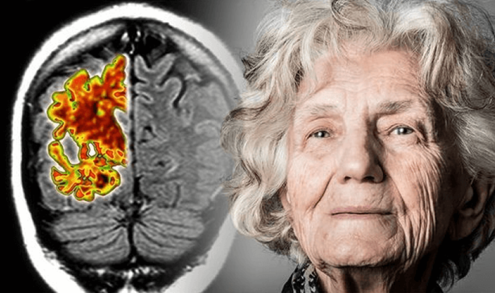 20260131 _ 슈퍼 에이저 유전자, 80대 뇌를 지키는 두 단서 _ 2-1.png