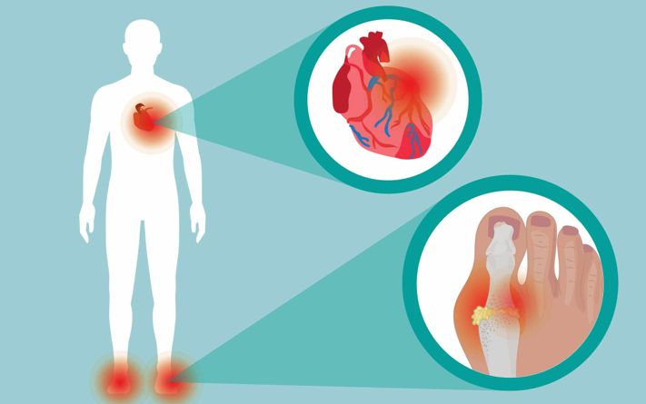 20260205 _ 통풍 치료, 심근경색·뇌졸중 위험도 낮출까 _ 2-1.png