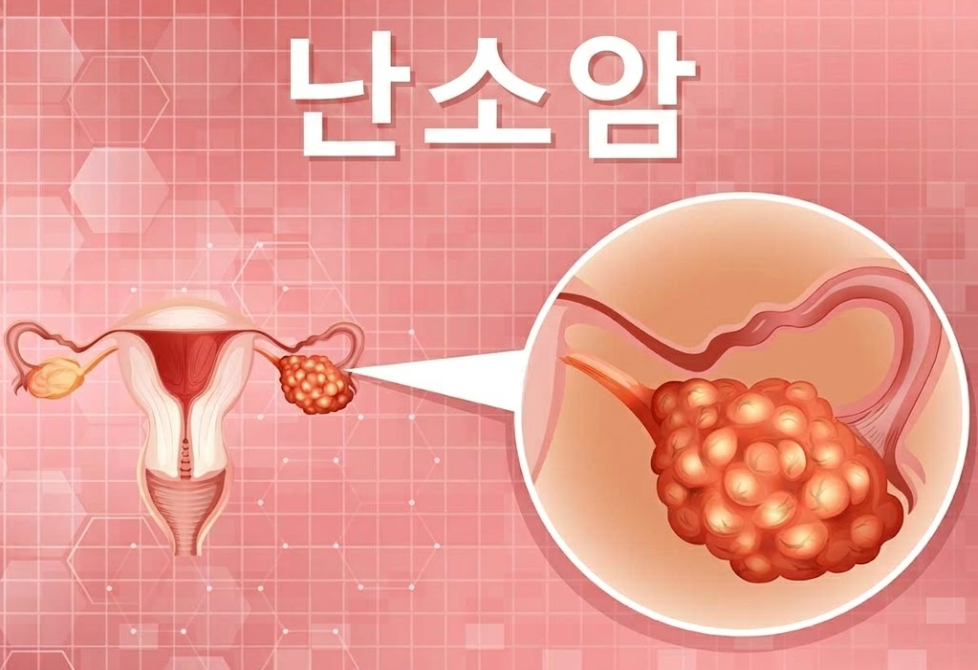 20260418 _ 라돈 가스, 난소암 위험까지 높인다 _ 2-1.png