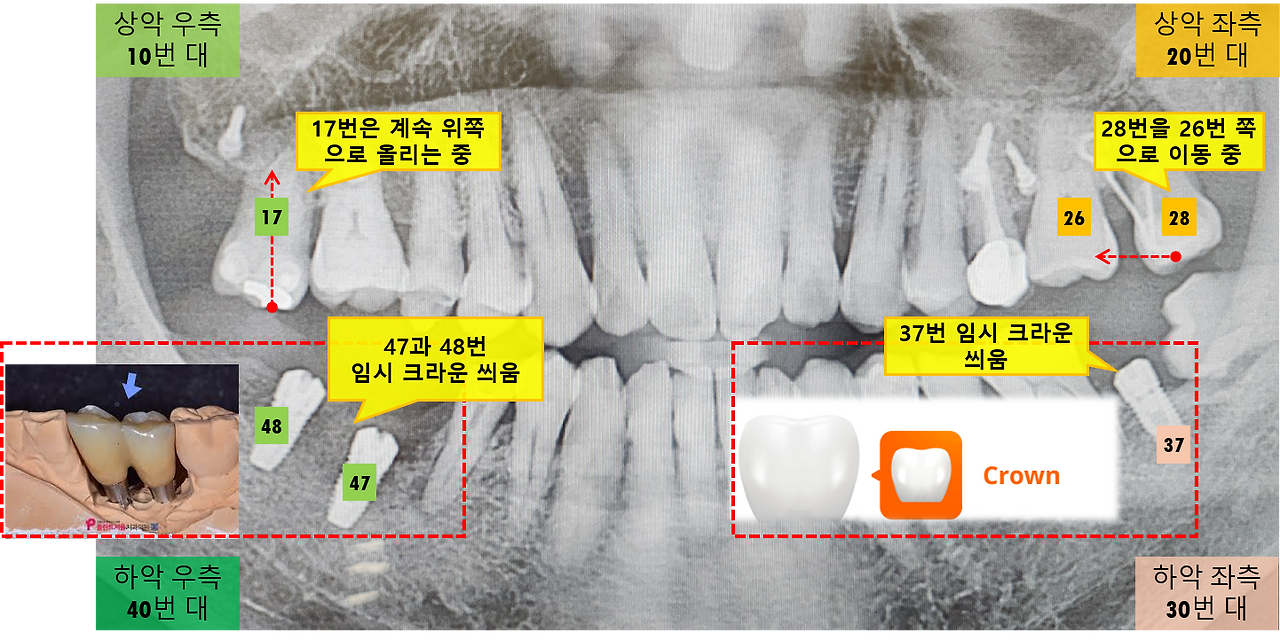 모든 임플란트 임시 크라운 부착.png