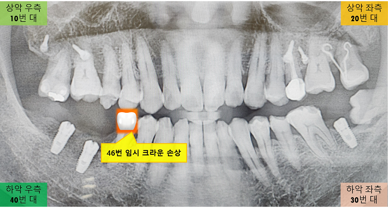 46번 크라운 손상.png