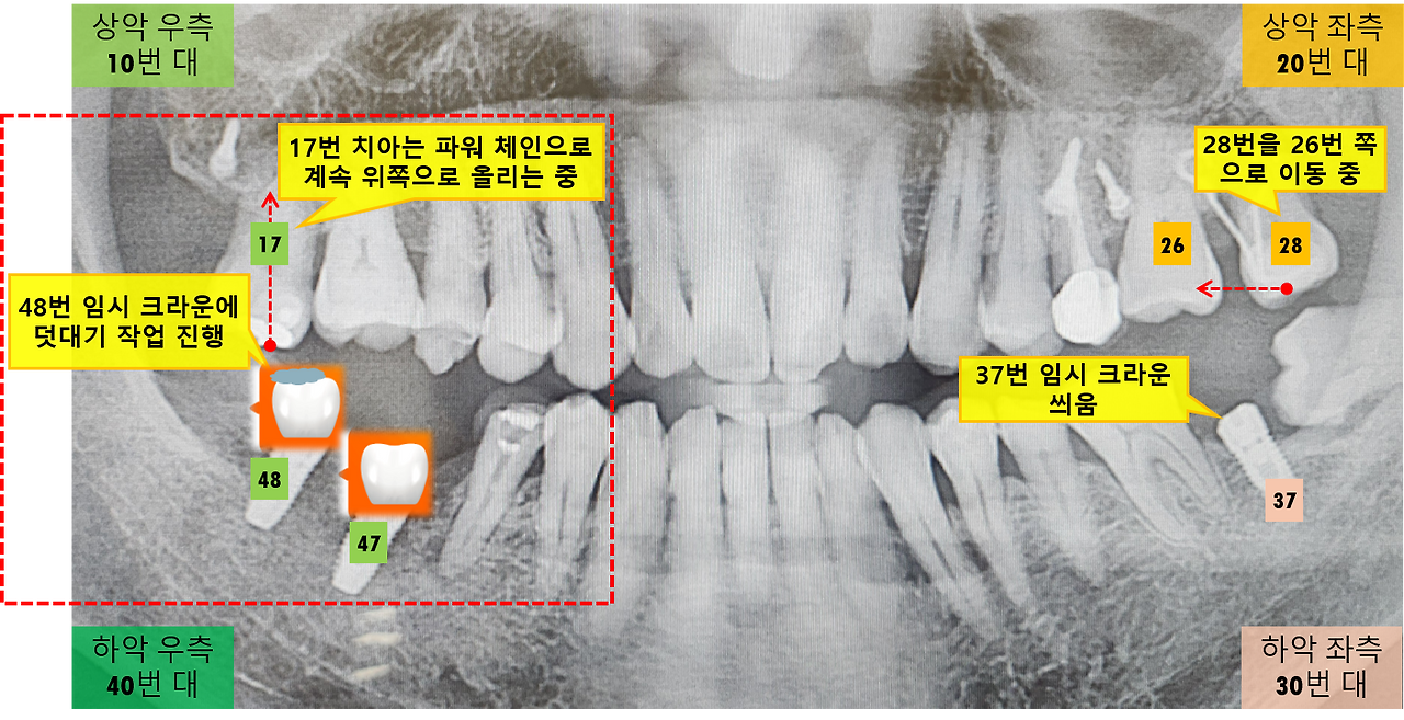 47번 임시 크라운 덧대기.png