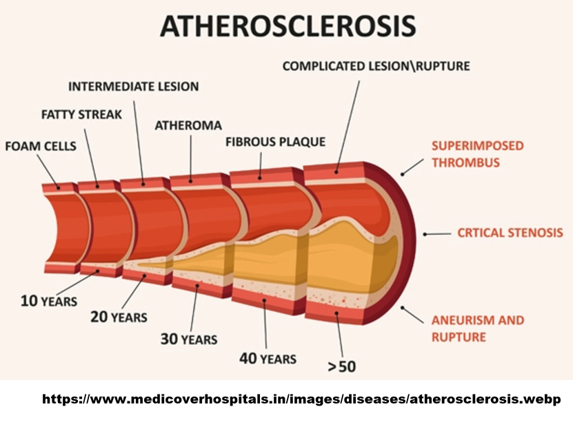 Atherosclerosis.png